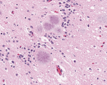 Image: Light photomicrograph of brain tissue reveals the presence of typical amyloid plaques found in a case of variant Creutzfeldt-Jakob disease (vCJD). Magnified 158x, and stained by the H&E (hematoxylin and eosin) staining technique (Photo courtesy of the US Centers for Disease Control (CDC)).